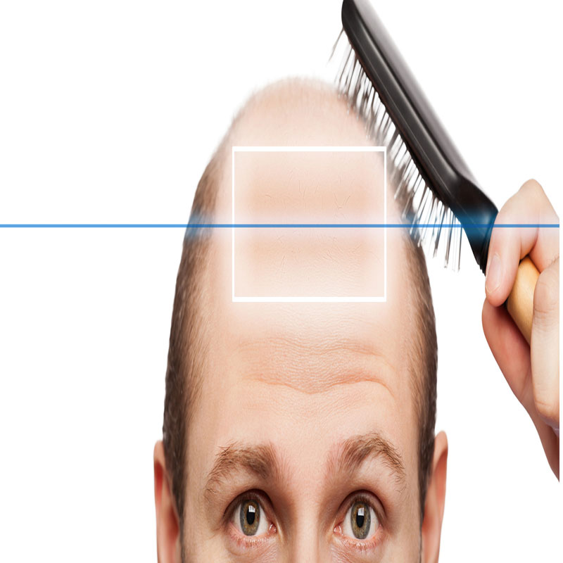 Hair transplant vadodara,Anand,Bharuch,Gujarat