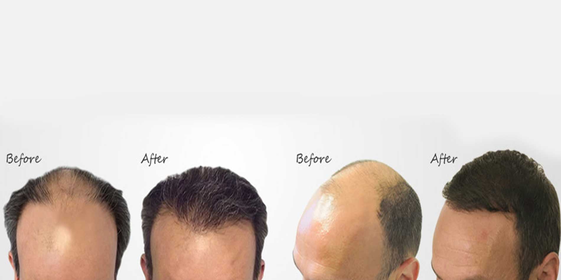 Hair transplant vadodara